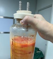 宣汉水动力吸脂手术要做多久？